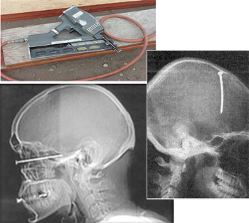 nailer and x-rays of individuals injured through their skulls.